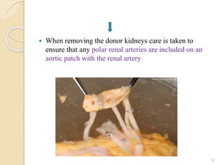  When removing the donor kidneys care is taken to
ensure that any polar renal arteries are included on an
aortic patch with the renal artery
36
 