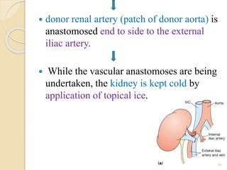  donor renal artery (patch of donor aorta) is
anastomosed end to side to the external
iliac artery.
 While the vascular anastomoses are being
undertaken, the kidney is kept cold by
application of topical ice.
39
 