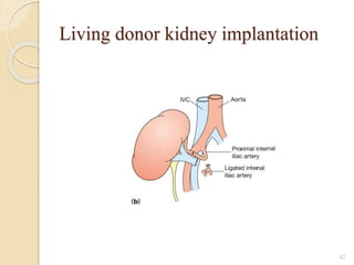 Living donor kidney implantation
42
 
