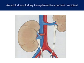 An adult donor kidney transplanted to a pediatric recipient
 
