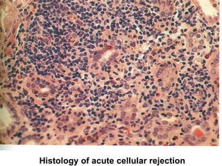 Histology of acute cellular rejection
 