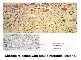 Chronic rejection with tubulointerstitial lesions.
 