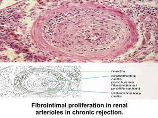 Fibrointimal proliferation in renal
arterioles in chronic rejection.
 