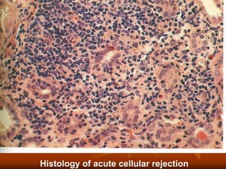Histology of acute cellular rejection
 