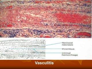 Vasculitis
 