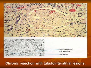 Chronic rejection with tubulointerstitial lesions.
 