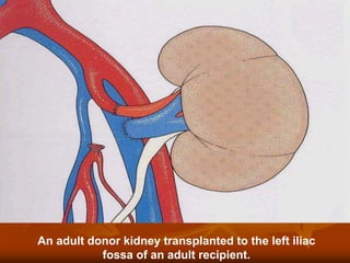 An adult donor kidney transplanted to the left iliac
fossa of an adult recipient.
 
