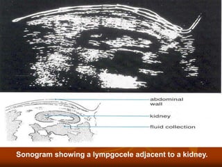 Sonogram showing a lympgocele adjacent to a kidney.
 