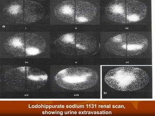 Lodohippurate sodium 1131 renal scan,
showing urine extravasation
 