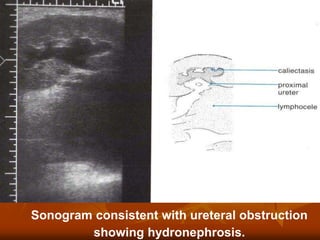 Sonogram consistent with ureteral obstruction
showing hydronephrosis.
 