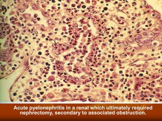 Acute pyelonephritis in a renal which ultimately required
nephrectomy, secondary to associated obstruction.
 