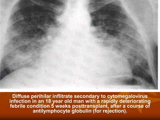 Diffuse perihilar inflitrate secondary to cytomegalovirus
infection in an 18 year old man with a rapidly deteriorating
febrile condition 5 weeks posttransplant, after a course of
antilymphocyte globulin (for rejection).
 