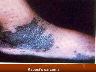 Kaposi’s sarcoma
 
