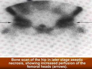 Bone scan of the hip in later stage aseptic
necrosis, showing increased perfusion of the
femoral heads (arrows).
 