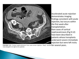 Accelerated acute rejection
demonstrates imaging
findings consistent with acute
rejection, but occurs within
the first week after
transplantation.
Rare cases of cortical
nephrocalcinosis (Fig.9.12)
have been described in
patients whose transplants
underwent severe immediate
rejection but were left insitu
for several years.
 