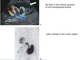 No flow in the inferior portion
of the transplanted kidney
Little isotope in the same region
 