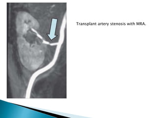 Transplant artery stenosis with MRA.
 