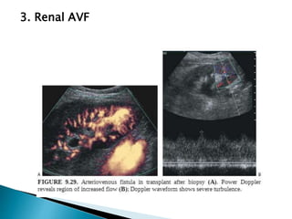 3. Renal AVF
 