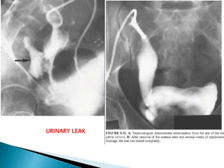 URINARY LEAK
 