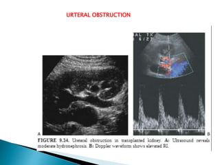 URTERAL OBSTRUCTION
 