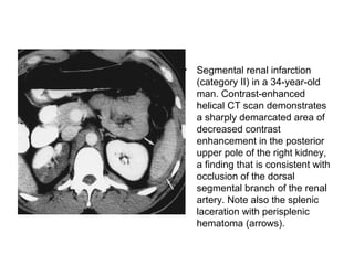 Devascularization Ct Renal trauma | PPT