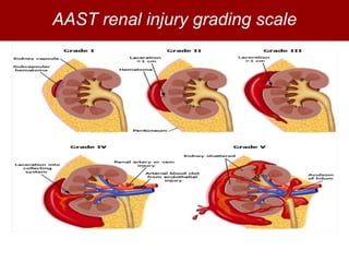 Renal Trauma | PPTX