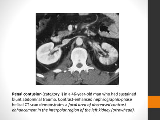 Renal contusion (category I) in a 46-year-old man who had sustained
blunt abdominal trauma. Contrast-enhanced nephrographic-phase
helical CT scan demonstrates a focal area of decreased contrast
enhancement in the interpolar region of the left kidney (arrowhead).
 