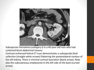 Subcapsular hematoma (category I) in a 40-year-old man who had
sustained blunt abdominal trauma.
Contrast-enhanced helical CT scan demonstrates a subcapsular fluid
collection (straight white arrows) flattening the posterolateral contour of
the left kidney. There is minimal cortical laceration (black arrow). Note
also the subcutaneous emphysema in the left side of the back (curved
arrow)
 