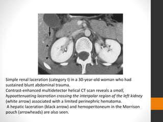 Simple renal laceration (category I) in a 30-year-old woman who had
sustained blunt abdominal trauma.
Contrast-enhanced multidetector helical CT scan reveals a small,
hypoattenuating laceration crossing the interpolar region of the left kidney
(white arrow) associated with a limited perinephric hematoma.
A hepatic laceration (black arrow) and hemoperitoneum in the Morrison
pouch (arrowheads) are also seen.
 