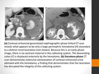 (a) Contrast-enhanced generalized-nephrographic-phase helical CT scan
reveals what appears to be only a large perinephric hematoma (H) secondary
to a distinct renal laceration (not shown). Because this is an early-phase
image, there is no contrast material in the collecting system. The descending
colon (C) is displaced anteriorly by the hematoma. (b) Excretory-phase CT
scan demonstrates extensive extravasation of contrast-enhanced urine
admixed with the hematoma, a finding that demonstrates that the laceration
has disrupted the integrity of the collecting system.
 