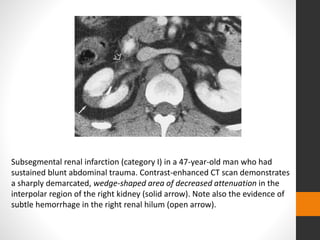 Subsegmental renal infarction (category I) in a 47-year-old man who had
sustained blunt abdominal trauma. Contrast-enhanced CT scan demonstrates
a sharply demarcated, wedge-shaped area of decreased attenuation in the
interpolar region of the right kidney (solid arrow). Note also the evidence of
subtle hemorrhage in the right renal hilum (open arrow).
 