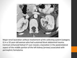 Major renal laceration without involvement of the collecting system (category
II) in a 32-year-old woman who had sustained blunt abdominal trauma.
Contrast-enhanced helical CT scan reveals a laceration in the posterolateral
aspect of the middle portion of the left kidney (arrows) associated with
perinephric hematoma.
 