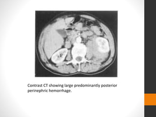 Contrast CT showing large predominantly posterior
perinephric hemorrhage.
 