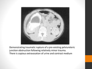 Demonstrating traumatic rupture of a pre-existing pelviureteric
junction obstruction following relatively minor trauma.
There is copious extravasation of urine and contrast medium
 