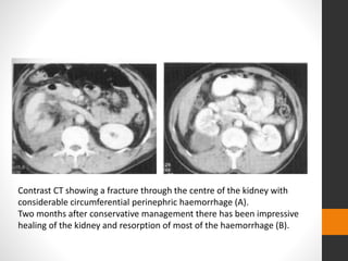 Contrast CT showing a fracture through the centre of the kidney with
considerable circumferential perinephric haemorrhage (A).
Two months after conservative management there has been impressive
healing of the kidney and resorption of most of the haemorrhage (B).
 