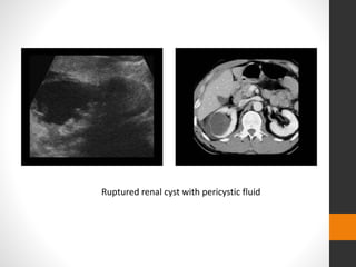 Ruptured renal cyst with pericystic fluid
 