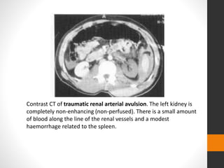 Contrast CT of traumatic renal arterial avulsion. The left kidney is
completely non-enhancing (non-perfused). There is a small amount
of blood along the line of the renal vessels and a modest
haemorrhage related to the spleen.
 