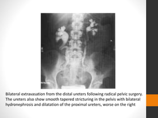 Bilateral extravasation from the distal ureters following radical pelvic surgery.
The ureters also show smooth tapered stricturing in the pelvis with bilateral
hydronephrosis and dilatation of the proximal ureters, worse on the right
 