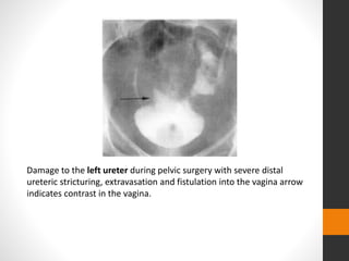 Damage to the left ureter during pelvic surgery with severe distal
ureteric stricturing, extravasation and fistulation into the vagina arrow
indicates contrast in the vagina.
 