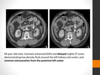 69 year old male. Contrast enhanced (left) and delayed (right) CT scans
demonstrating low density fluid around the left kidney and ureter, and
contrast extravasation from the proximal left ureter
 