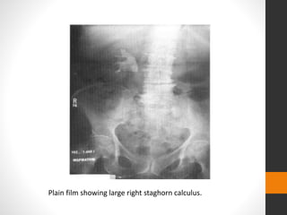 Plain film showing large right staghorn calculus.
 
