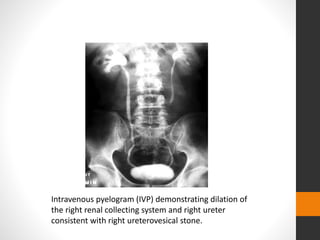 Intravenous pyelogram (IVP) demonstrating dilation of
the right renal collecting system and right ureter
consistent with right ureterovesical stone.
 