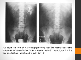 Full length film from an IVU series (A) showing stasis and mild fullness in the
left ureter and considerable oedema around the vesicoureteric junction due
to a small calculus visible on the plain film (B
 