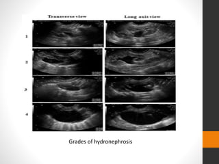 Grades of hydronephrosis
 