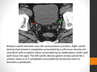 Bilateral calcific densities near the vesicoureteric junctions. Right calcific
density (red arrow) is completely surrounded by a soft tissue density rim
consistent with a ureteric stone surrounded by an oedematous ureter wall
(soft tissue rim sign). The left calcific density (green arrow) cannot be a
ureteric stone as it is completely surrounded by fat density and it is
therefore a phlebolith.
 