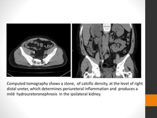 Computed tomography shows a stone, of calcific density, at the level of right
distal ureter, which determines periureteral inflammation and produces a
mild hydroureteronephrosis in the ipsilateral kidney.
 