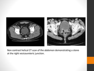Non contrast helical CT scan of the abdomen demonstrating a stone
at the right vesicoureteric junction.
 