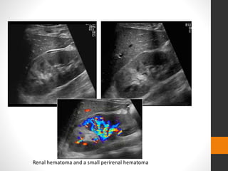 Renal hematoma and a small perirenal hematoma
 