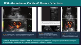 Caseated Comprehensive Review of Renal Tuberculosis: Pathophysiology, Imaging ...