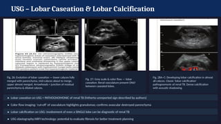 Caseated Comprehensive Review of Renal Tuberculosis: Pathophysiology, Imaging ...